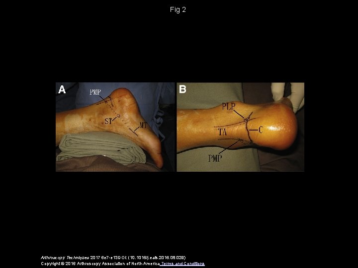 Fig 2 Arthroscopy Techniques 2017 6 e 7 -e 13 DOI: (10. 1016/j. eats.