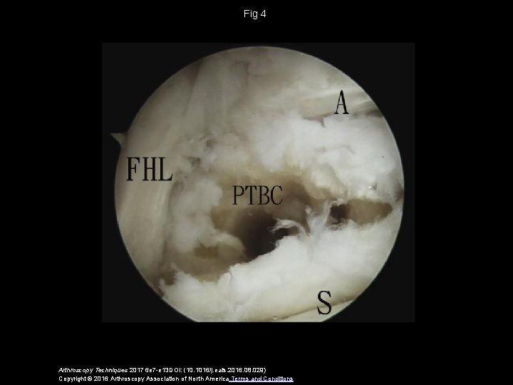 Fig 4 Arthroscopy Techniques 2017 6 e 7 -e 13 DOI: (10. 1016/j. eats.