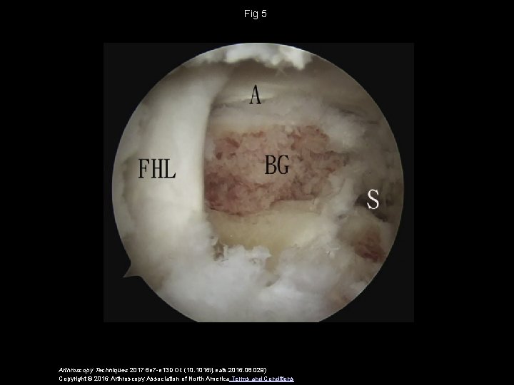 Fig 5 Arthroscopy Techniques 2017 6 e 7 -e 13 DOI: (10. 1016/j. eats.