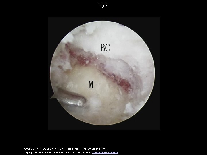 Fig 7 Arthroscopy Techniques 2017 6 e 7 -e 13 DOI: (10. 1016/j. eats.