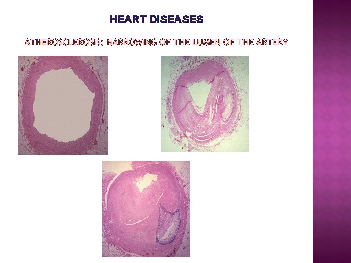 HEART DISEASES 