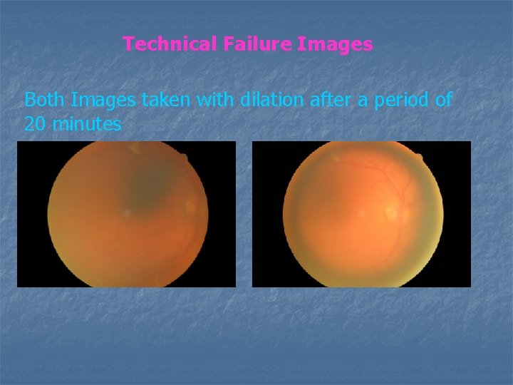 Technical Failure Images Both Images taken with dilation after a period of 20 minutes