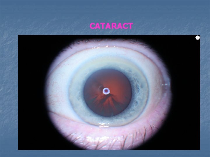 CATARACT 