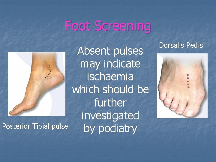 Foot Screening Posterior Tibial pulse Absent pulses may indicate ischaemia which should be further
