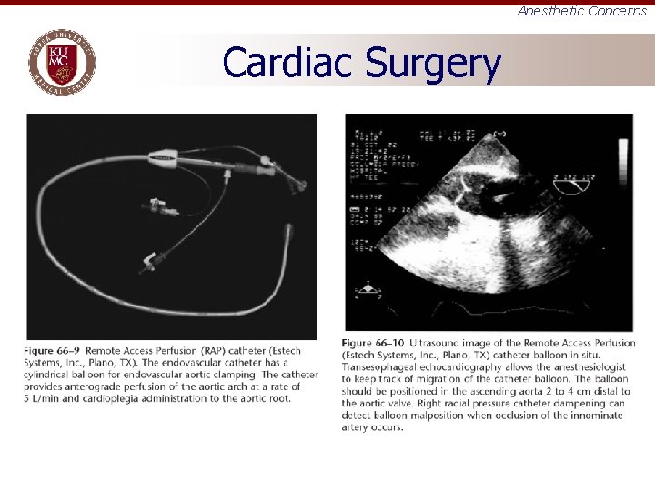 Anesthetic Concerns Cardiac Surgery 