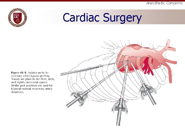 Anesthetic Concerns Cardiac Surgery 