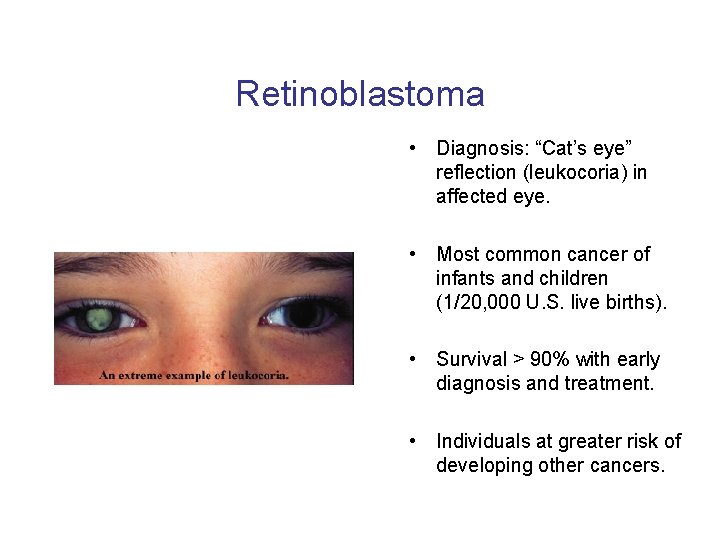 Retinoblastoma • Diagnosis: “Cat’s eye” reflection (leukocoria) in affected eye. • Most common cancer