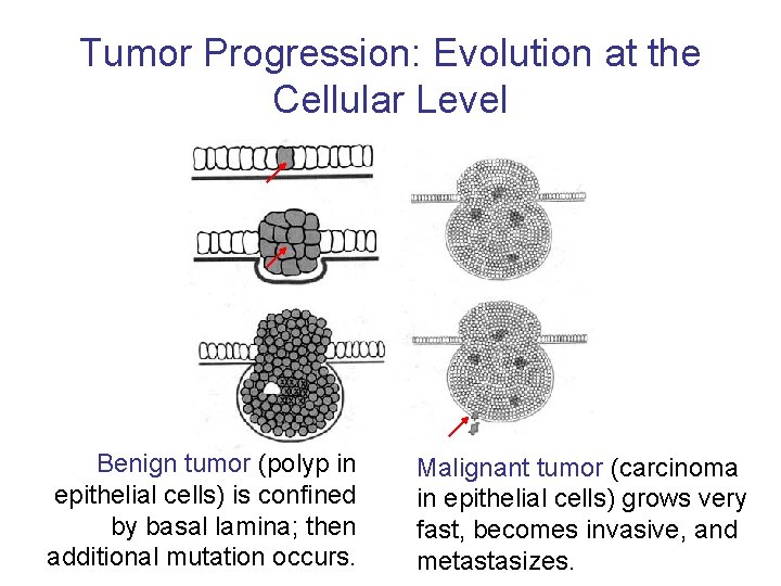 Tumor Progression: Evolution at the Cellular Level Benign tumor (polyp in epithelial cells) is