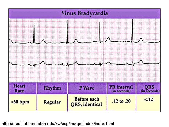 http: //medstat. med. utah. edu/kw/ecg/image_index/index. html 