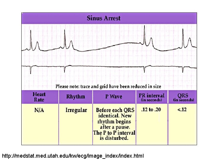 http: //medstat. med. utah. edu/kw/ecg/image_index/index. html 