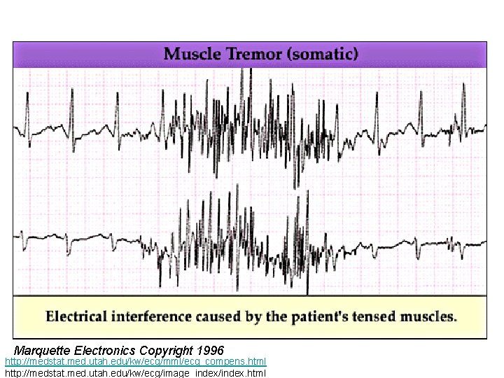 Marquette Electronics Copyright 1996 http: //medstat. med. utah. edu/kw/ecg/mml/ecg_compens. html http: //medstat. med. utah.