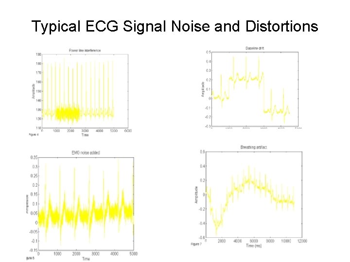 Typical ECG Signal Noise and Distortions 