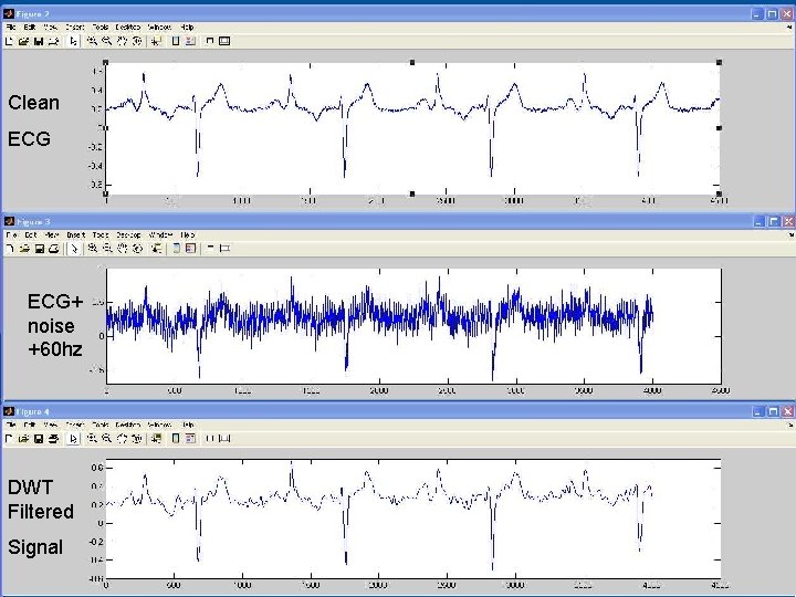 Clean ECG+ noise +60 hz DWT Filtered Signal 