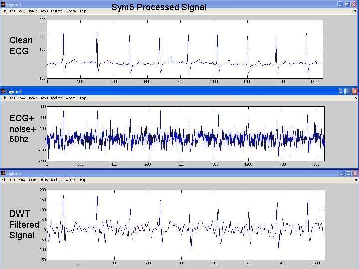Sym 5 Processed Signal Clean ECG+ noise+ 60 hz DWT Filtered Signal 