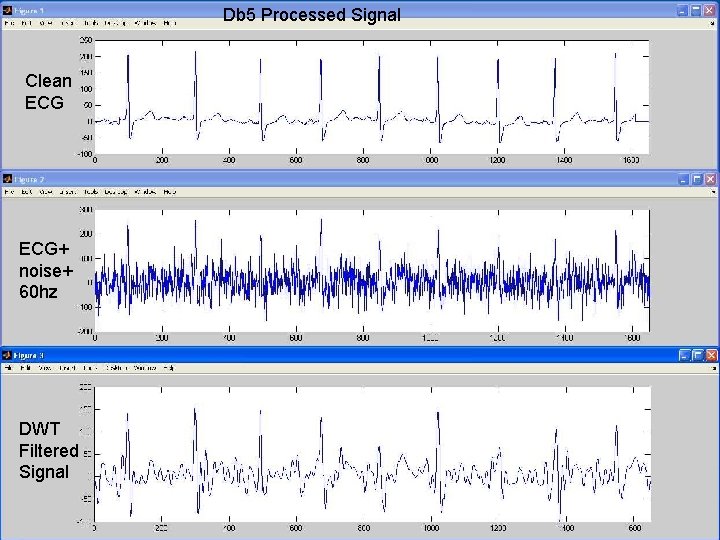Db 5 Processed Signal Clean ECG+ noise+ 60 hz DWT Filtered Signal 