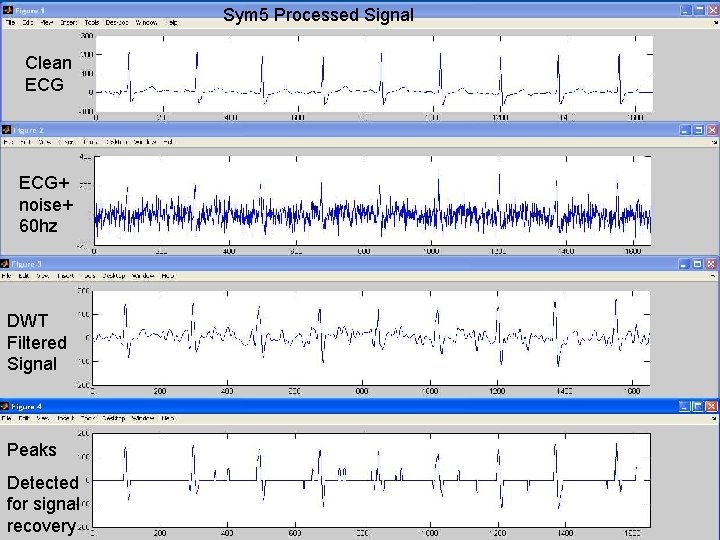 Sym 5 Processed Signal Clean ECG+ noise+ 60 hz DWT Filtered Signal Peaks Detected