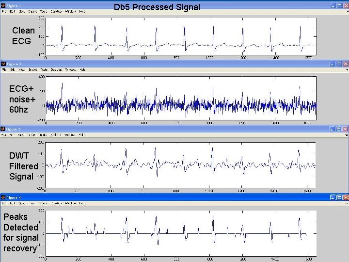 Db 5 Processed Signal Clean ECG+ noise+ 60 hz DWT Filtered Signal Peaks Detected
