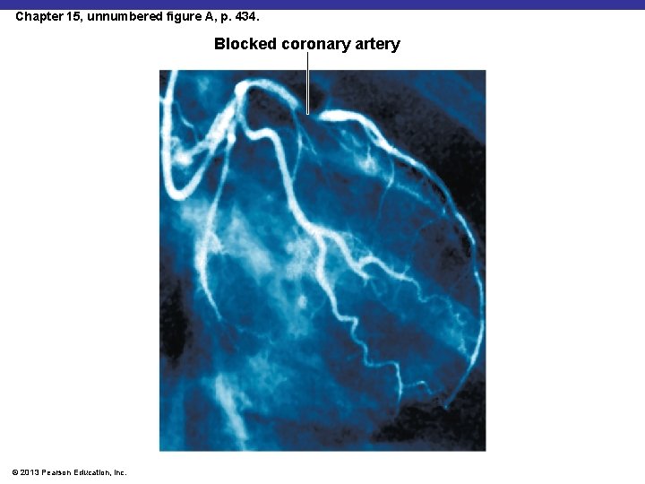 Chapter 15, unnumbered figure A, p. 434. Blocked coronary artery © 2013 Pearson Education,