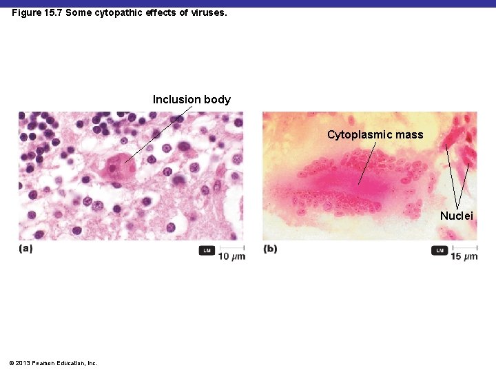 Figure 15. 7 Some cytopathic effects of viruses. Inclusion body Cytoplasmic mass Nuclei ©