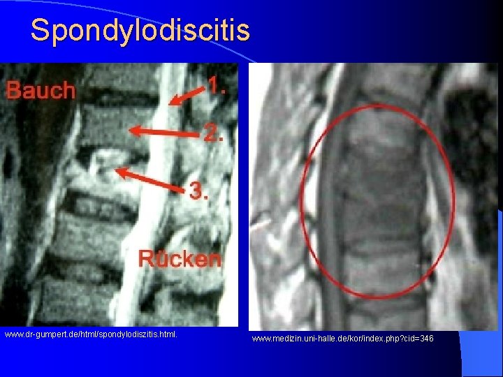 Spondylodiscitis www. dr-gumpert. de/html/spondylodiszitis. html. www. medizin. uni-halle. de/kor/index. php? cid=346 