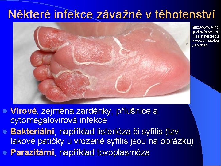 Některé infekce závažné v těhotenství http: //www. adhb. govt. nz/newborn /Teaching. Resou rces/Dermatolog y/Syphilis