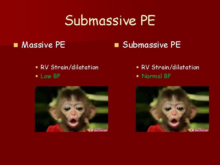 Submassive PE n Massive PE § RV Strain/dilatation § Low BP n Submassive PE