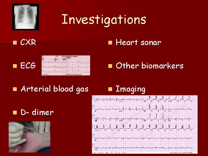 Investigations n CXR n Heart sonar n ECG n Other biomarkers n Arterial blood