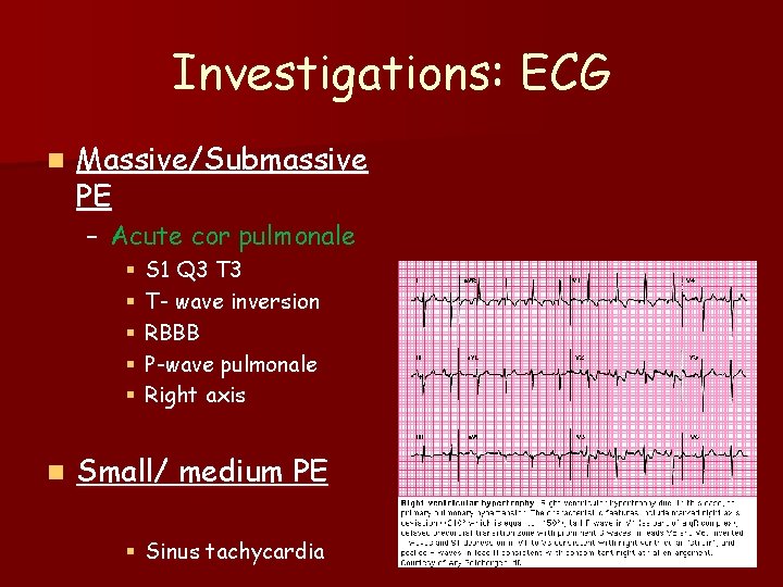 Investigations: ECG n Massive/Submassive PE – Acute cor pulmonale § § § n S