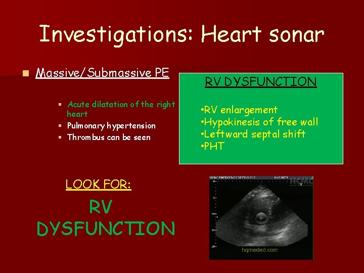 Investigations: Heart sonar n Massive/Submassive PE § Acute dilatation of the right heart §