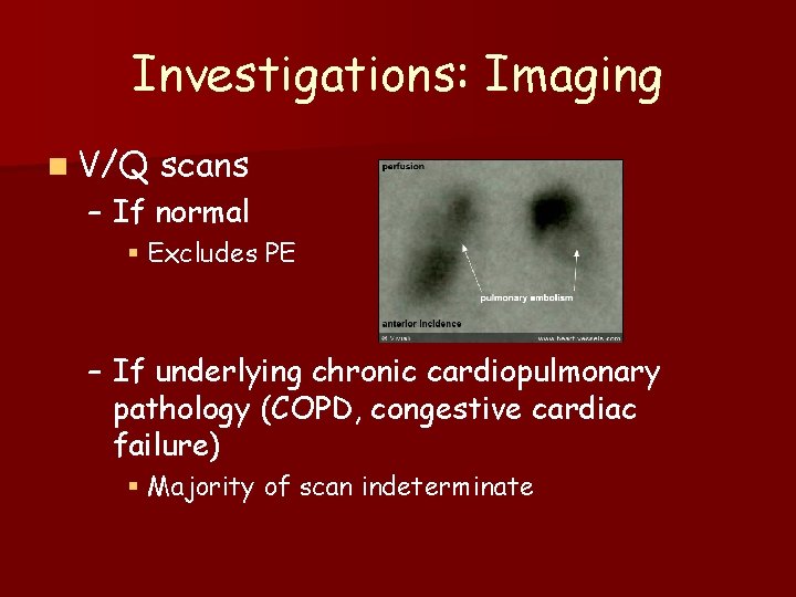 Investigations: Imaging n V/Q scans – If normal § Excludes PE – If underlying