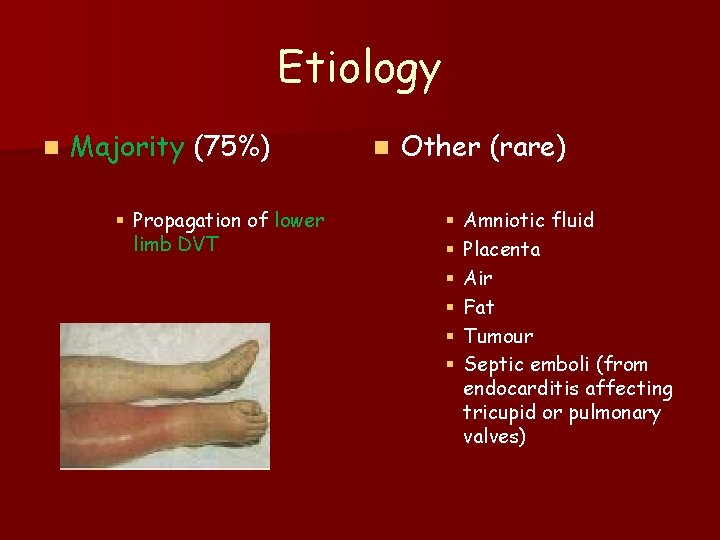 Etiology n Majority (75%) § Propagation of lower limb DVT n Other (rare) §