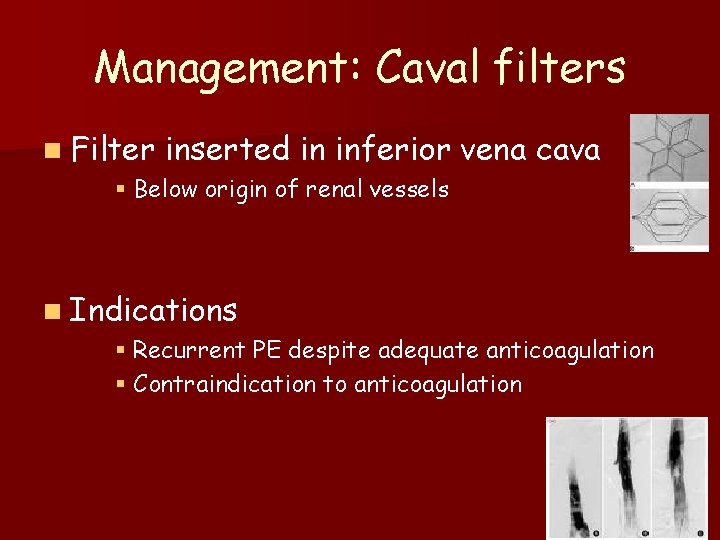 Management: Caval filters n Filter inserted in inferior vena cava § Below origin of