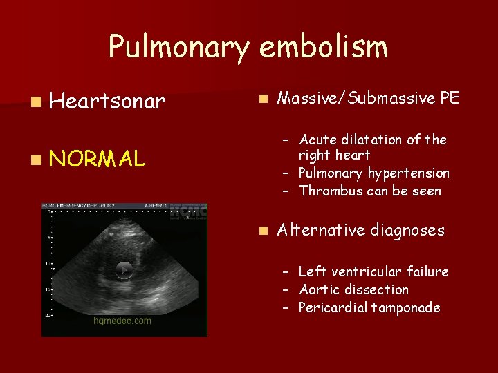 Pulmonary embolism n Heartsonar n Massive/Submassive PE – Acute dilatation of the right heart