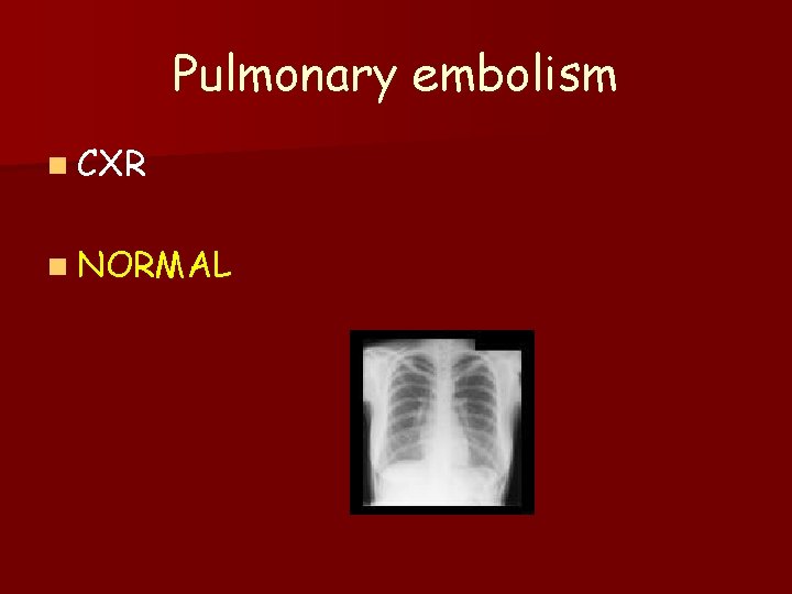 Pulmonary embolism n CXR n NORMAL 