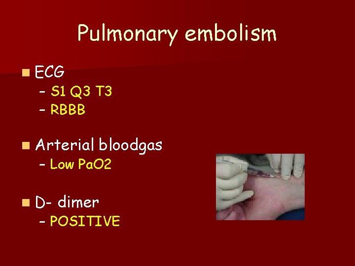 Pulmonary embolism n ECG – S 1 Q 3 T 3 – RBBB n