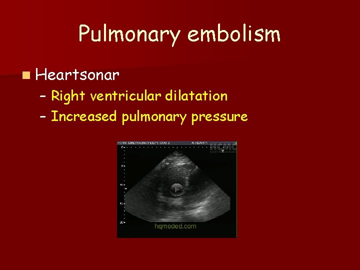 Pulmonary embolism n Heartsonar – Right ventricular dilatation – Increased pulmonary pressure 