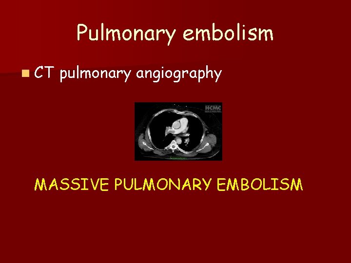 Pulmonary embolism n CT pulmonary angiography MASSIVE PULMONARY EMBOLISM 
