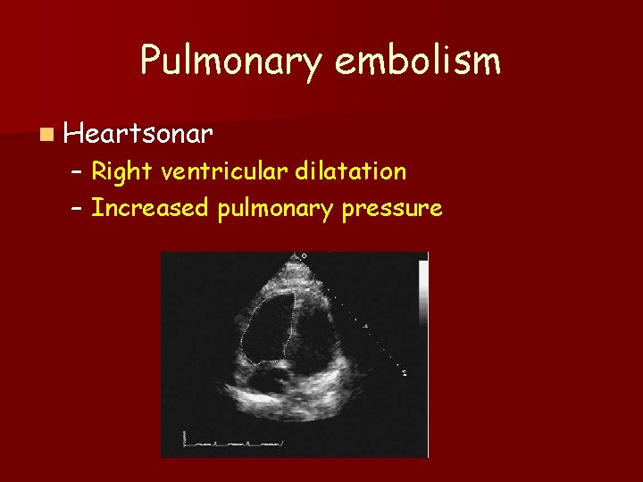 Pulmonary embolism n Heartsonar – Right ventricular dilatation – Increased pulmonary pressure 