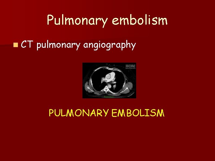 Pulmonary embolism n CT pulmonary angiography PULMONARY EMBOLISM 