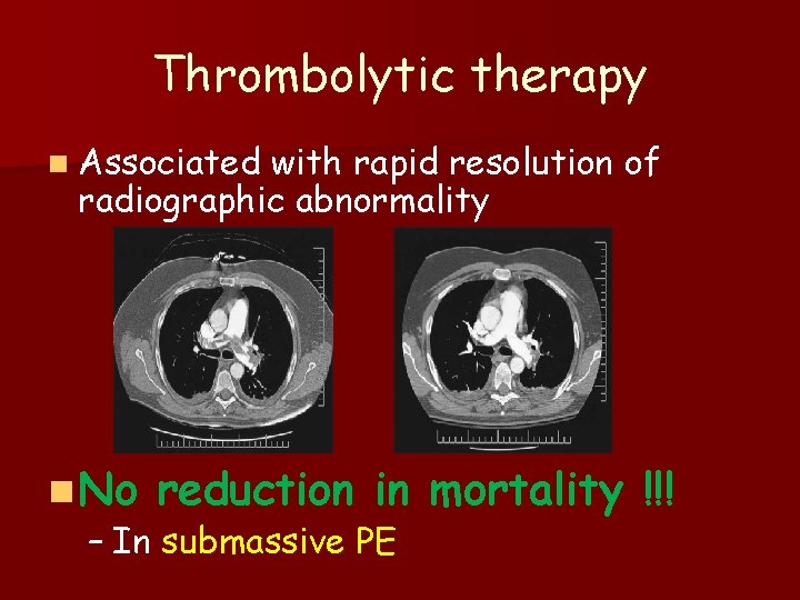 Thrombolytic therapy n Associated with rapid resolution of radiographic abnormality n No reduction in