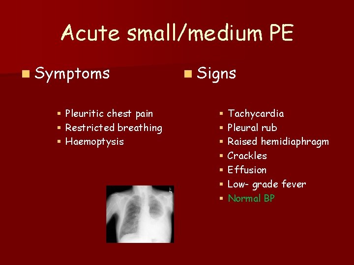 Acute small/medium PE n Symptoms § § § Pleuritic chest pain Restricted breathing Haemoptysis