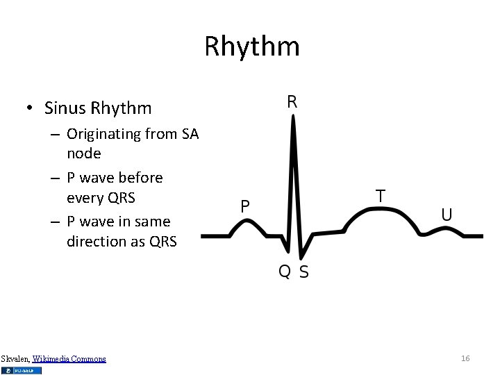 Rhythm • Sinus Rhythm – Originating from SA node – P wave before every