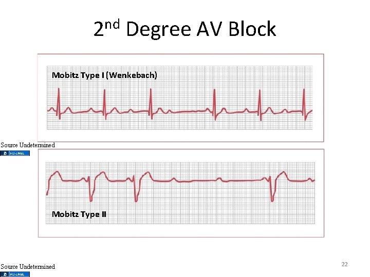 2 nd Degree AV Block Mobitz Type I (Wenkebach) Source Undetermined Mobitz Type II