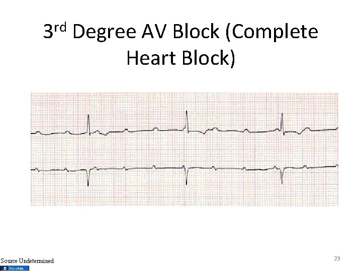 rd 3 Source Undetermined Degree AV Block (Complete Heart Block) 23 