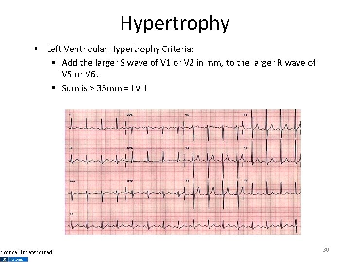 Hypertrophy § Left Ventricular Hypertrophy Criteria: § Add the larger S wave of V