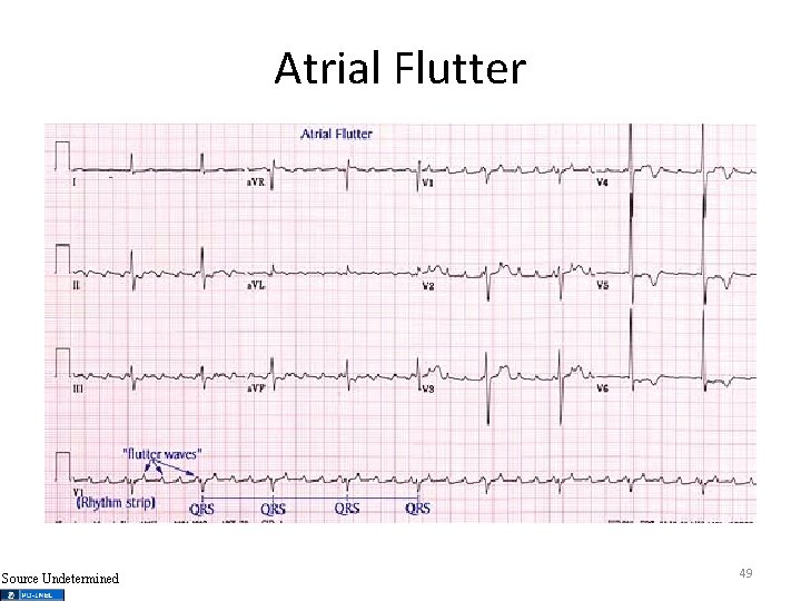 Atrial Flutter Source Undetermined 49 