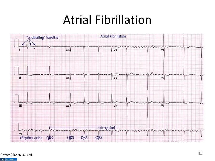 Atrial Fibrillation Source Undetermined 51 
