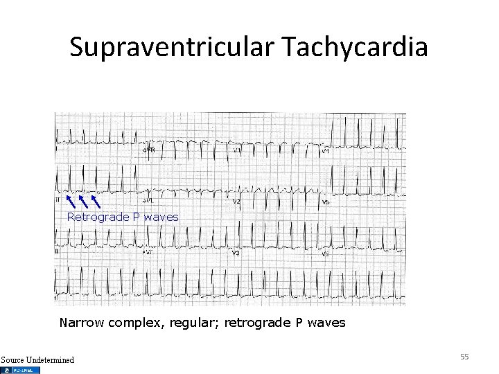 Supraventricular Tachycardia Retrograde P waves Narrow complex, regular; retrograde P waves Source Undetermined 55