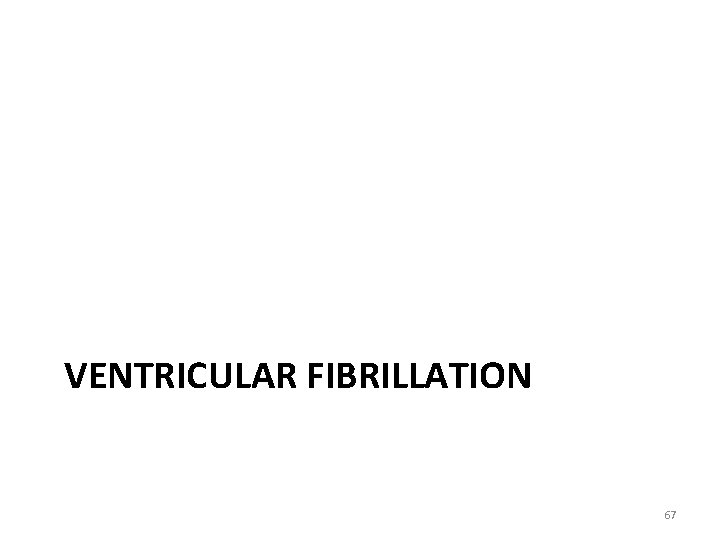 VENTRICULAR FIBRILLATION 67 