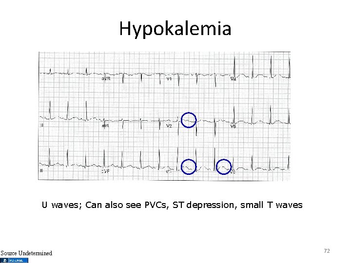 Hypokalemia U waves; Can also see PVCs, ST depression, small T waves Source Undetermined